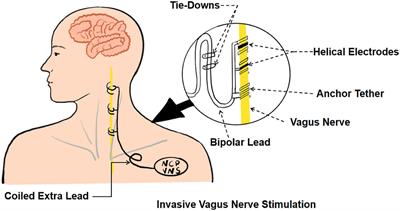 Research advances in the application of vagus nerve electrical stimulation in ischemic stroke